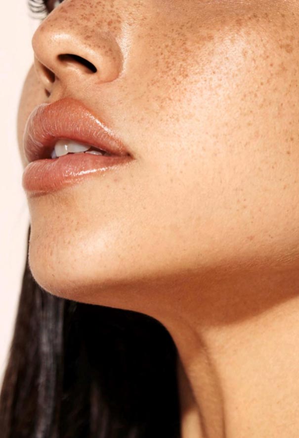 Beauchamp Aesthetics - Pigmentation What Is/